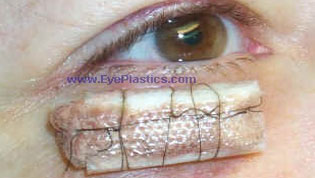 Excision of the tumor can be performed by a MOHS surgeon, an dermatologist, or an ophthalmic plastic surgeon